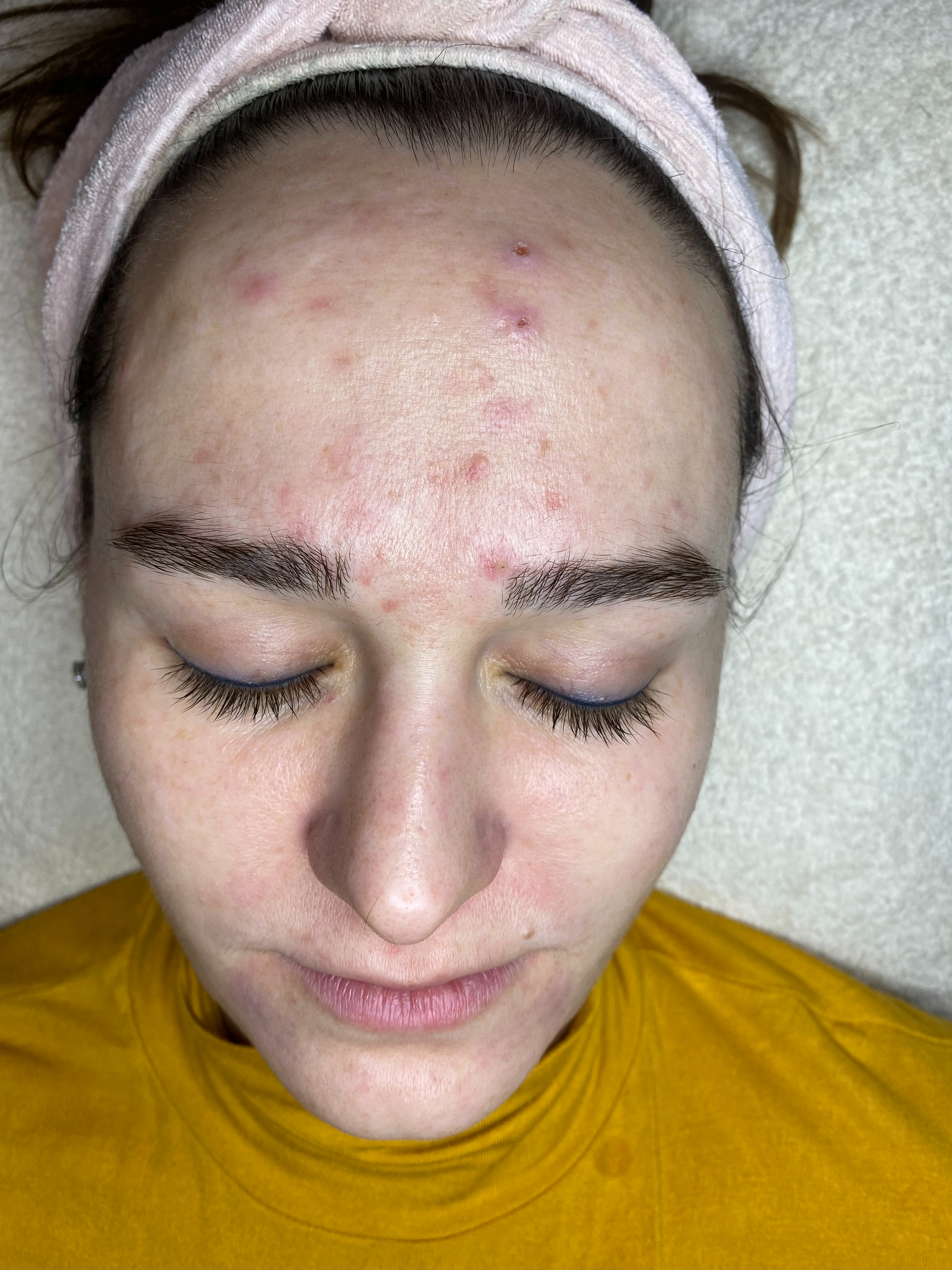 Arckezelés előtt készült közeli fotó