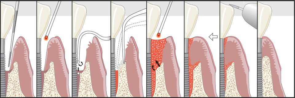 Illustration of how lapip works 8 pannels detailing the process showing the lazer targeting the unhealthy tissue, cleaning of the implant, clotting of the tissue and ending with a healthy gum. 