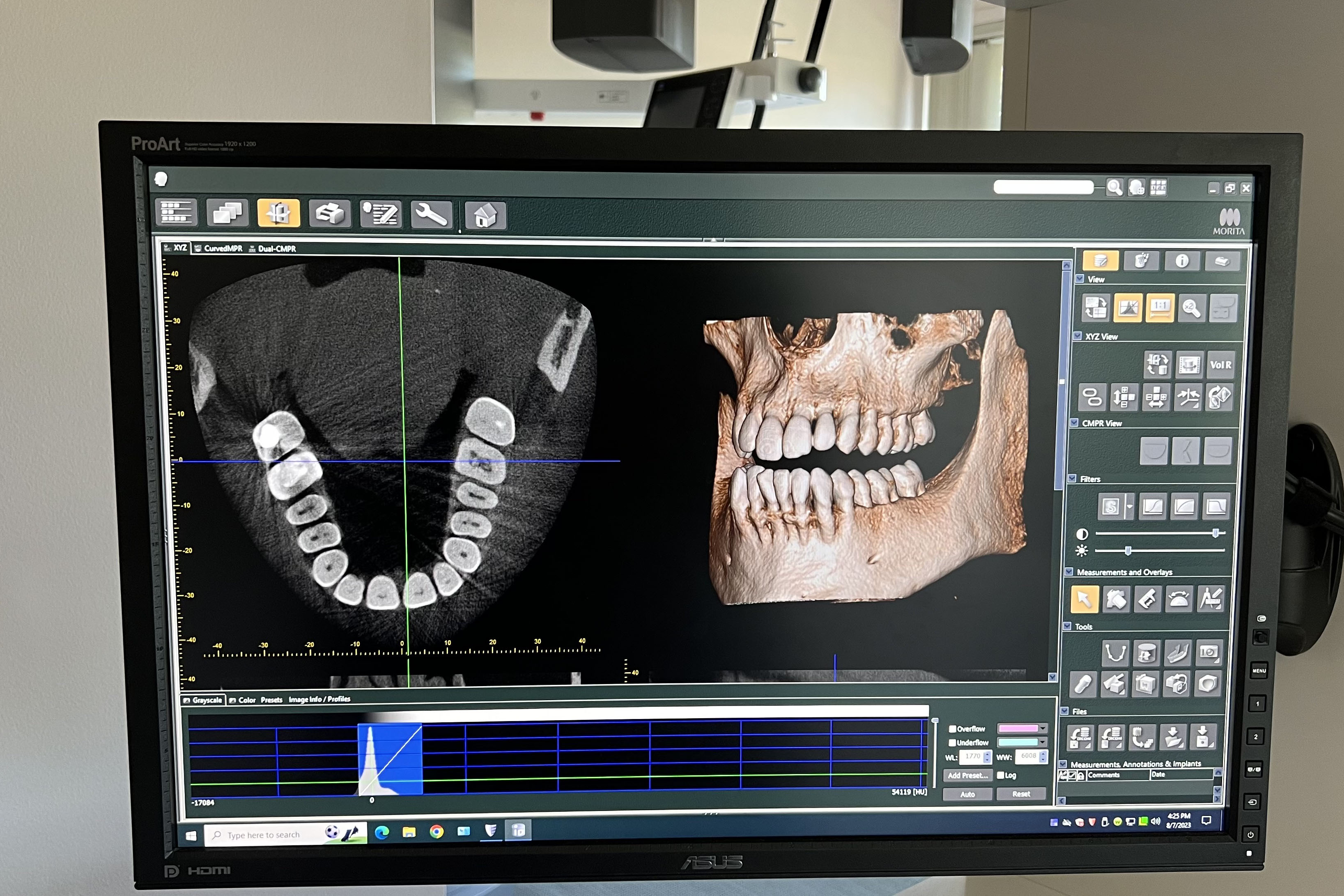 Photo of a computer screen mounted to a wall showing a CBCT with black and white slices of teeth on the left and a color 3d rendering looking bottom half three quarter view of a scull. There is a graph running across the bottom and a series of icons to the right. 