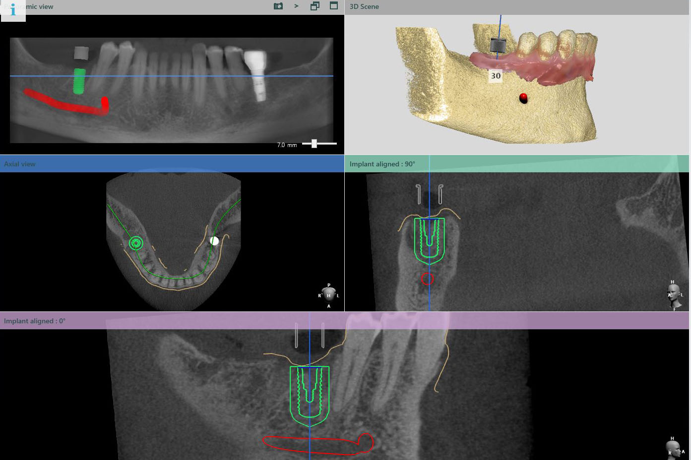 Image detailing digital implant treatment planing software showing the impant position from all views including 3D rendering. 