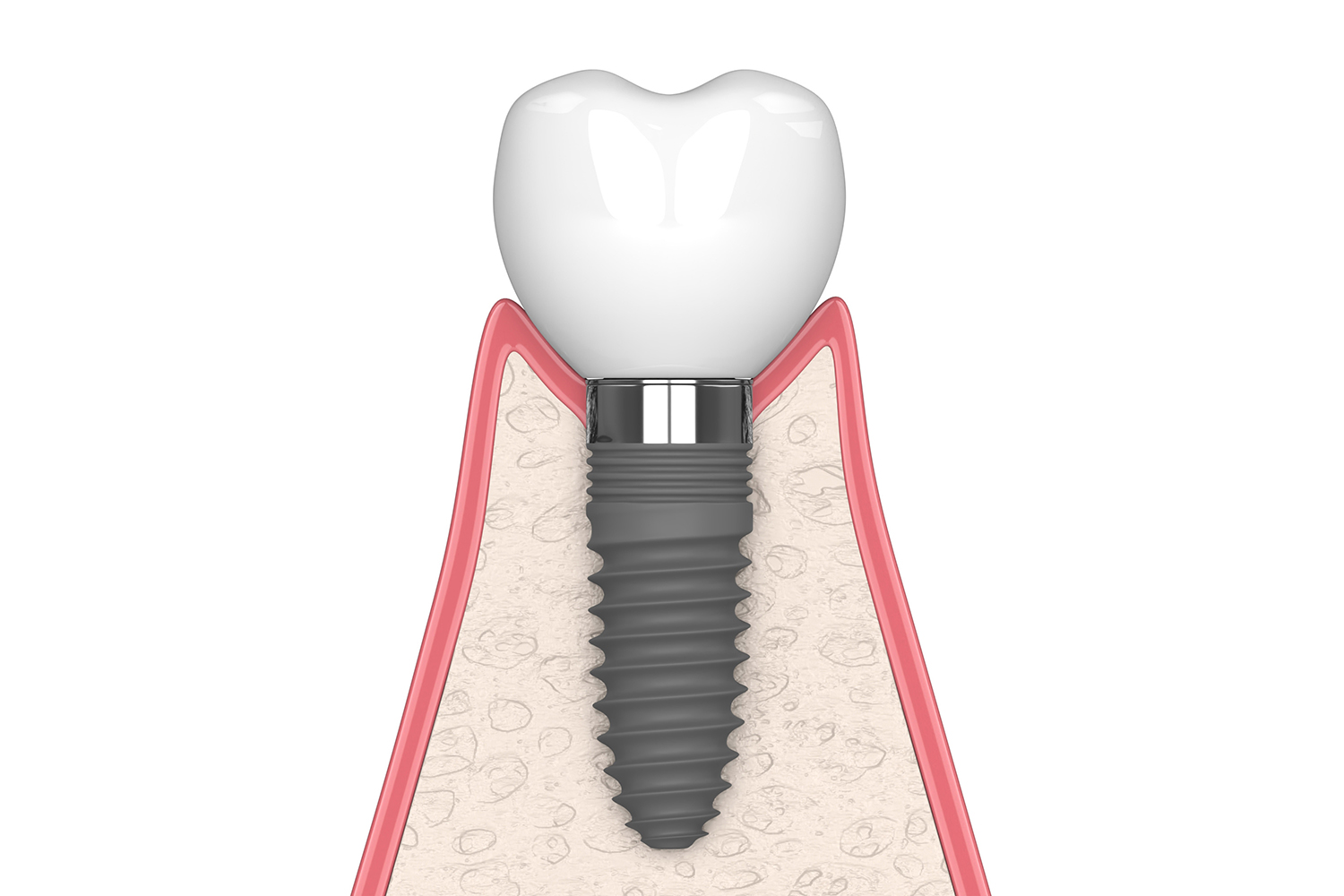 Cross section of a implant with crown showing healthy bone and gums