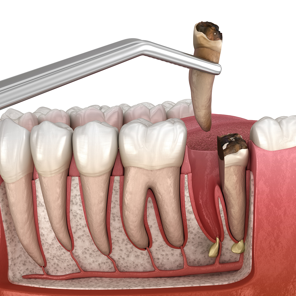 3D illustration of a section of a tooth being removed with forceps