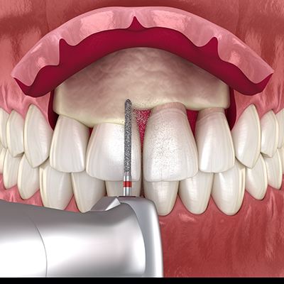 3d illustration of gum reflected with bur lengthening the crown of front tooth. 