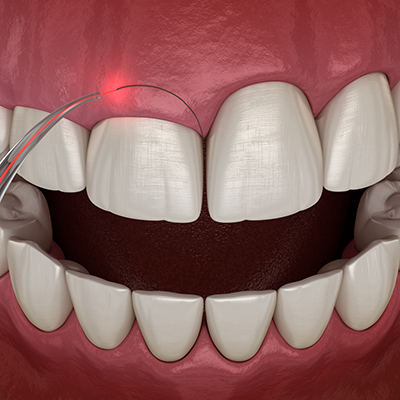 3d illustration of teeth with laser creating an arched incision above the front tooth
