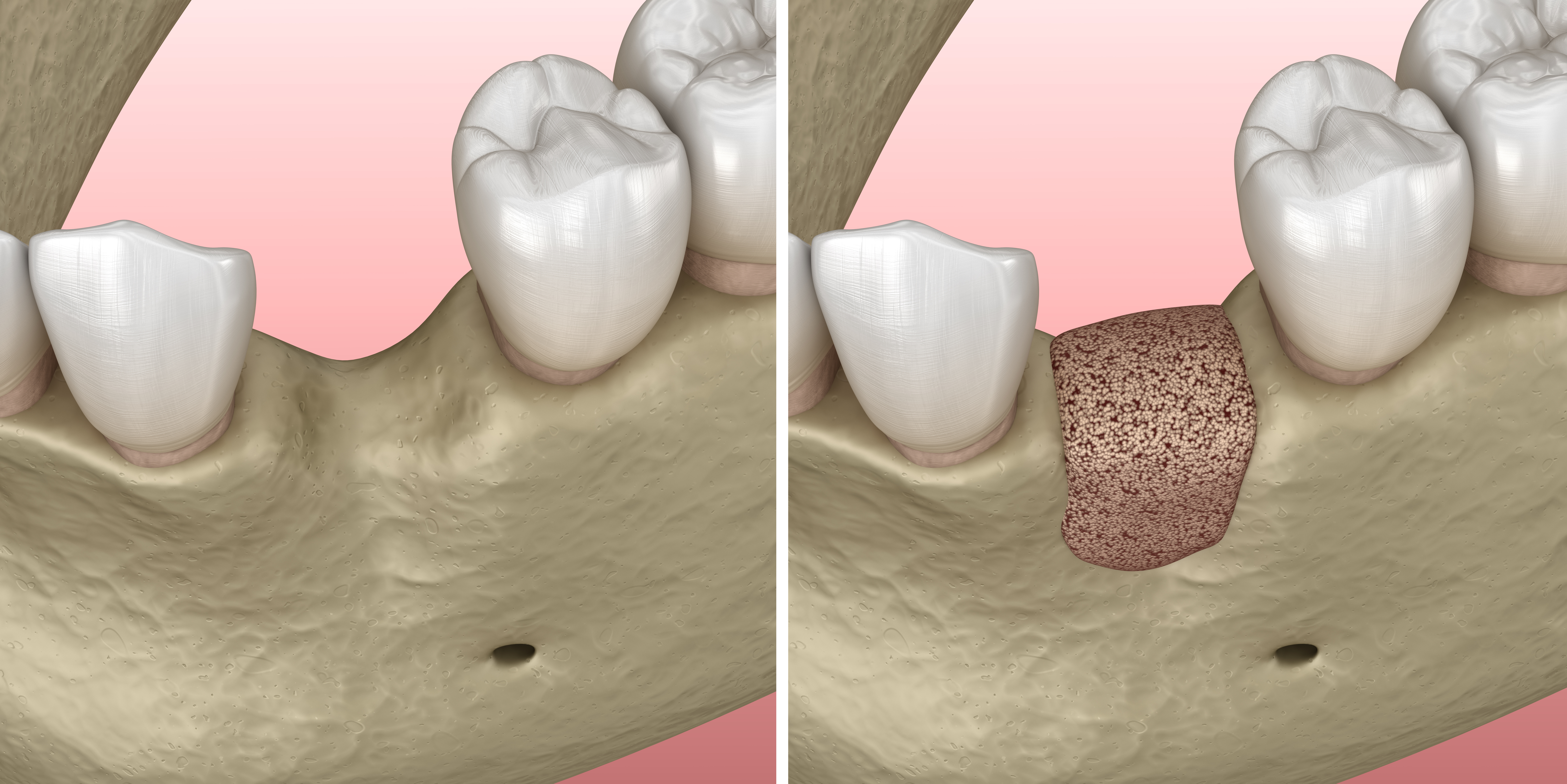 3D Illustration of Mandibular ridge augmentation before and after procedure