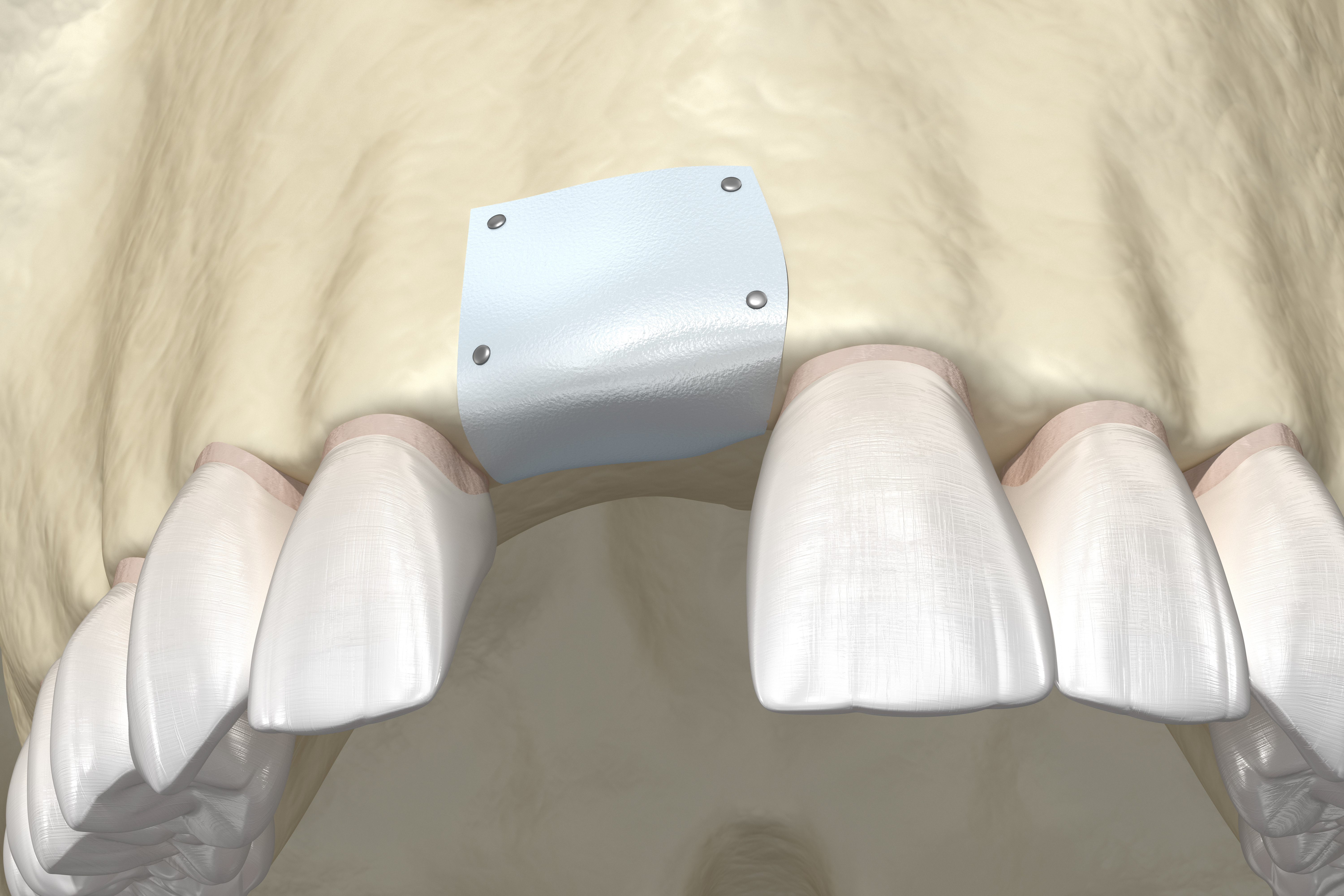 3D Illustration of Mandibular ridge augmentation after membrane is screwed into place