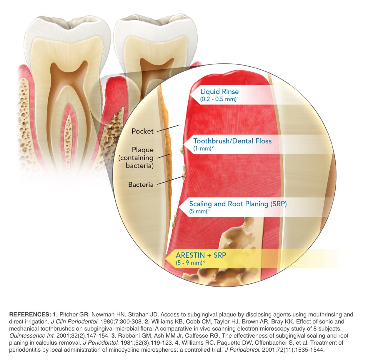 Illustration of two teeth with red gums separated from tooth and bone loss zoomed-in portion labeling the pocket, plaque, and bacteria on the left side with lines to area on the right side there are section arrows starting at the top Liquid Rinse 0.2-.5 mm, Followed by Toothbrush/ Dental floss 1mm, Scaling and Root Planing SRP 5mm, Arestin + SRP 5-9mm