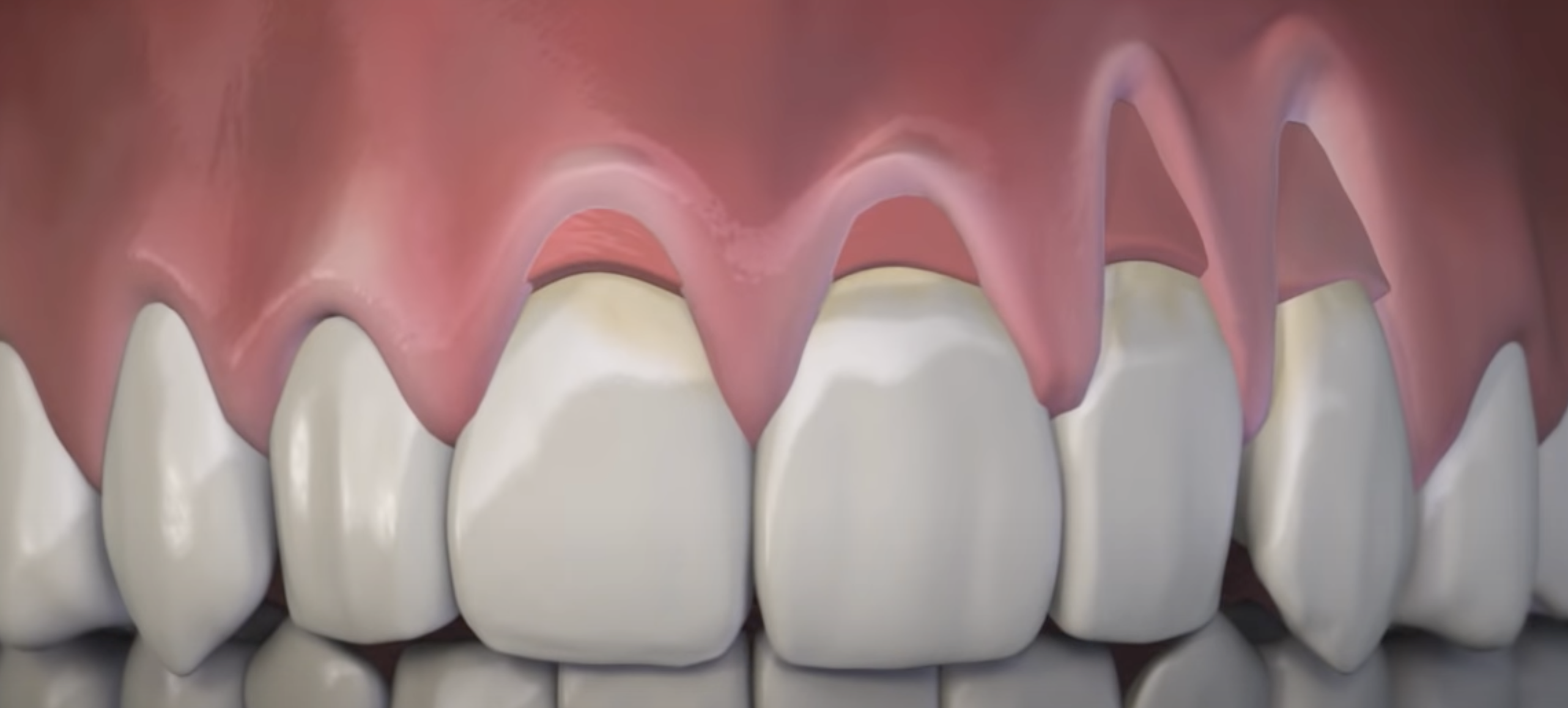 close up Illustration of upper front showing end teeth showing result of pinhole surgery