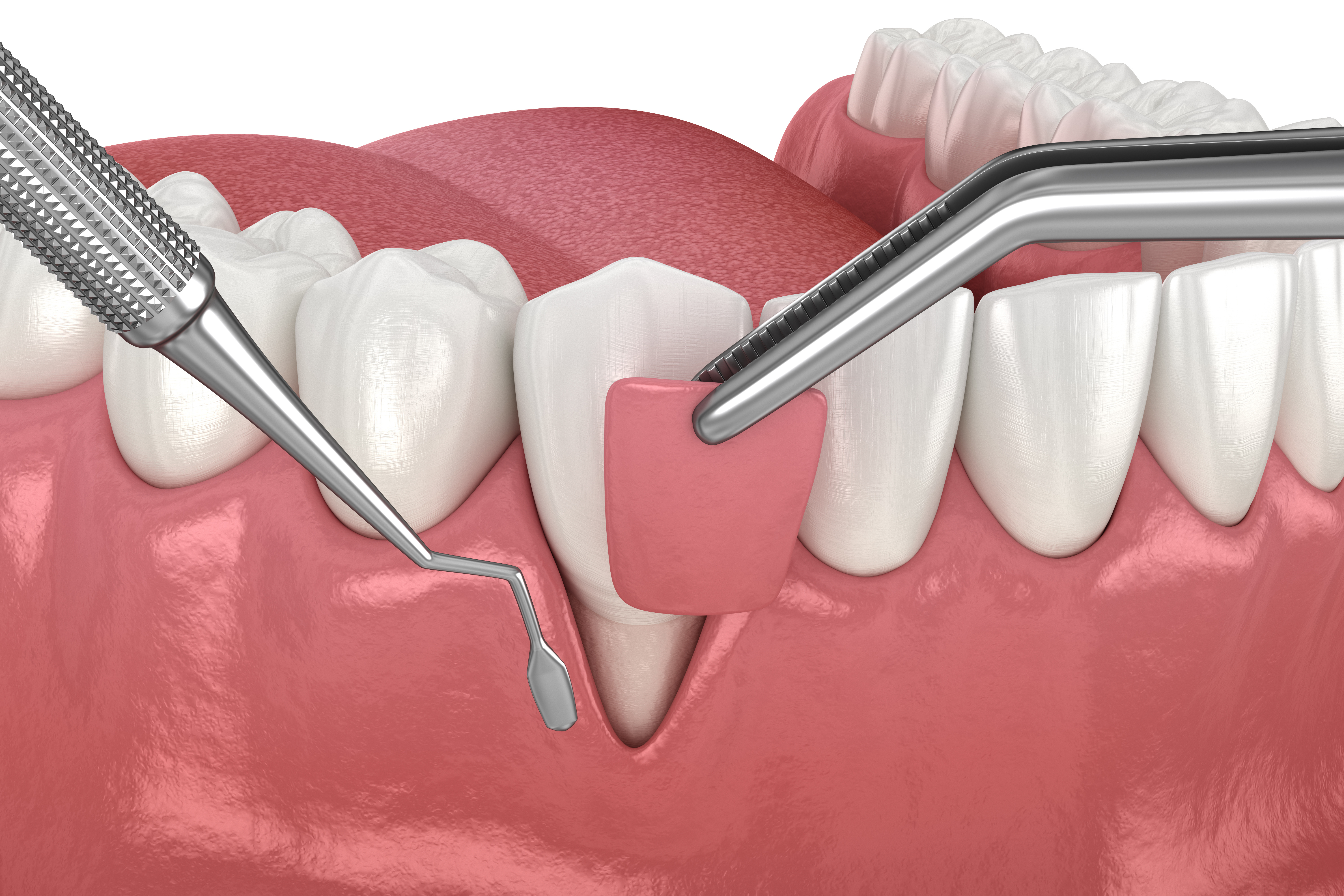 3D model of lower teeth showing a tissue graft being used to cover recession.
