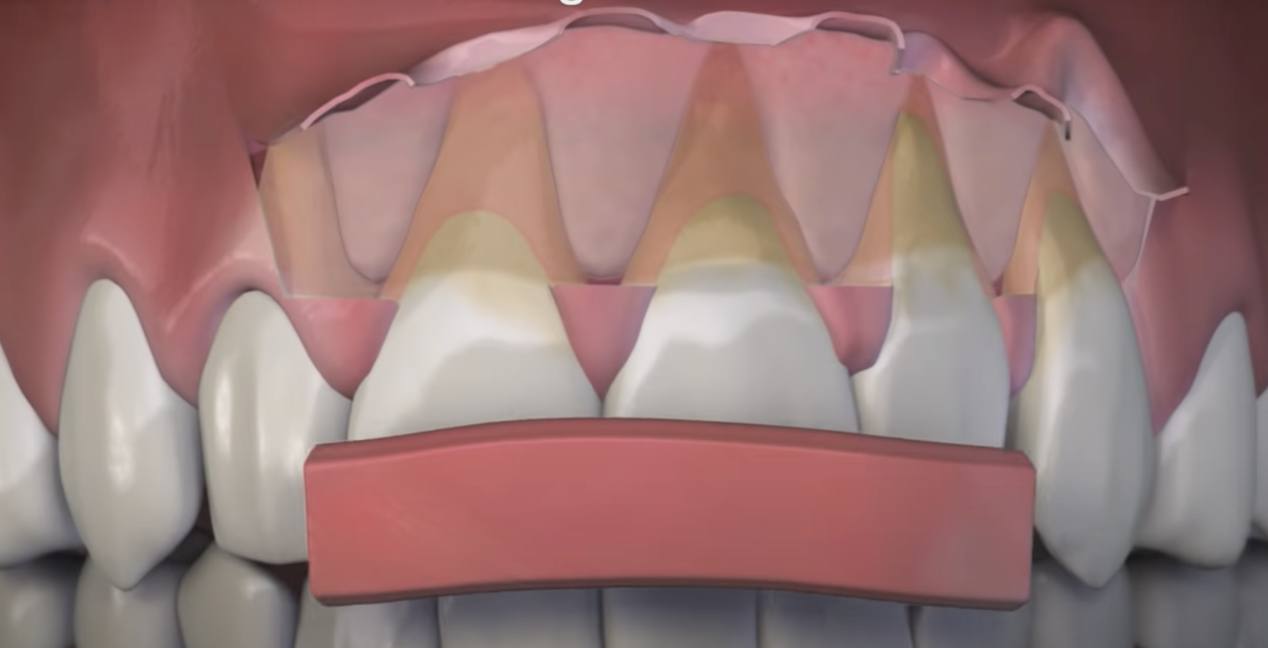 3D Illustration of upper jaw showing free gingival graft being place