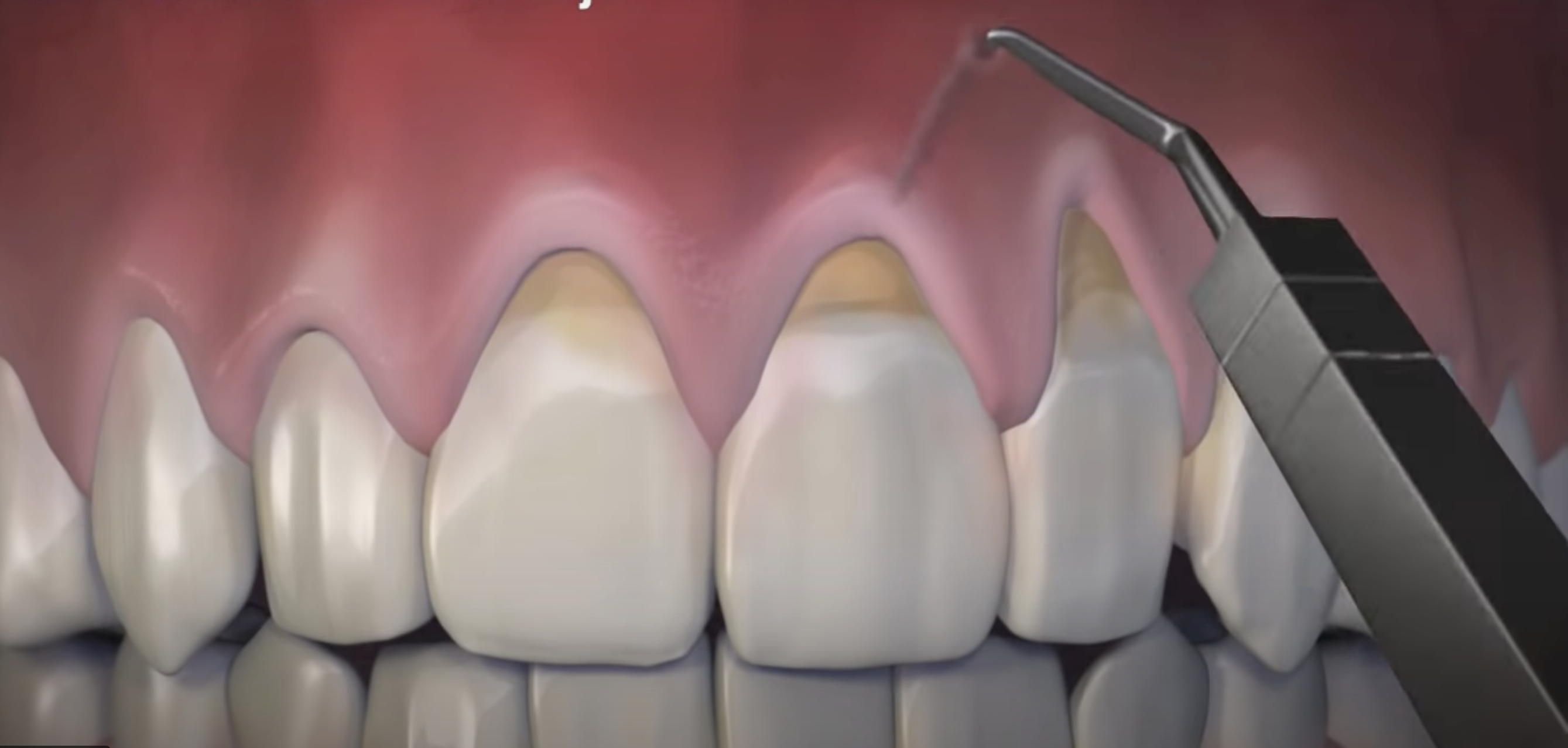 close up Illustration of upper front teeth with an instrument creating pinhole in gums