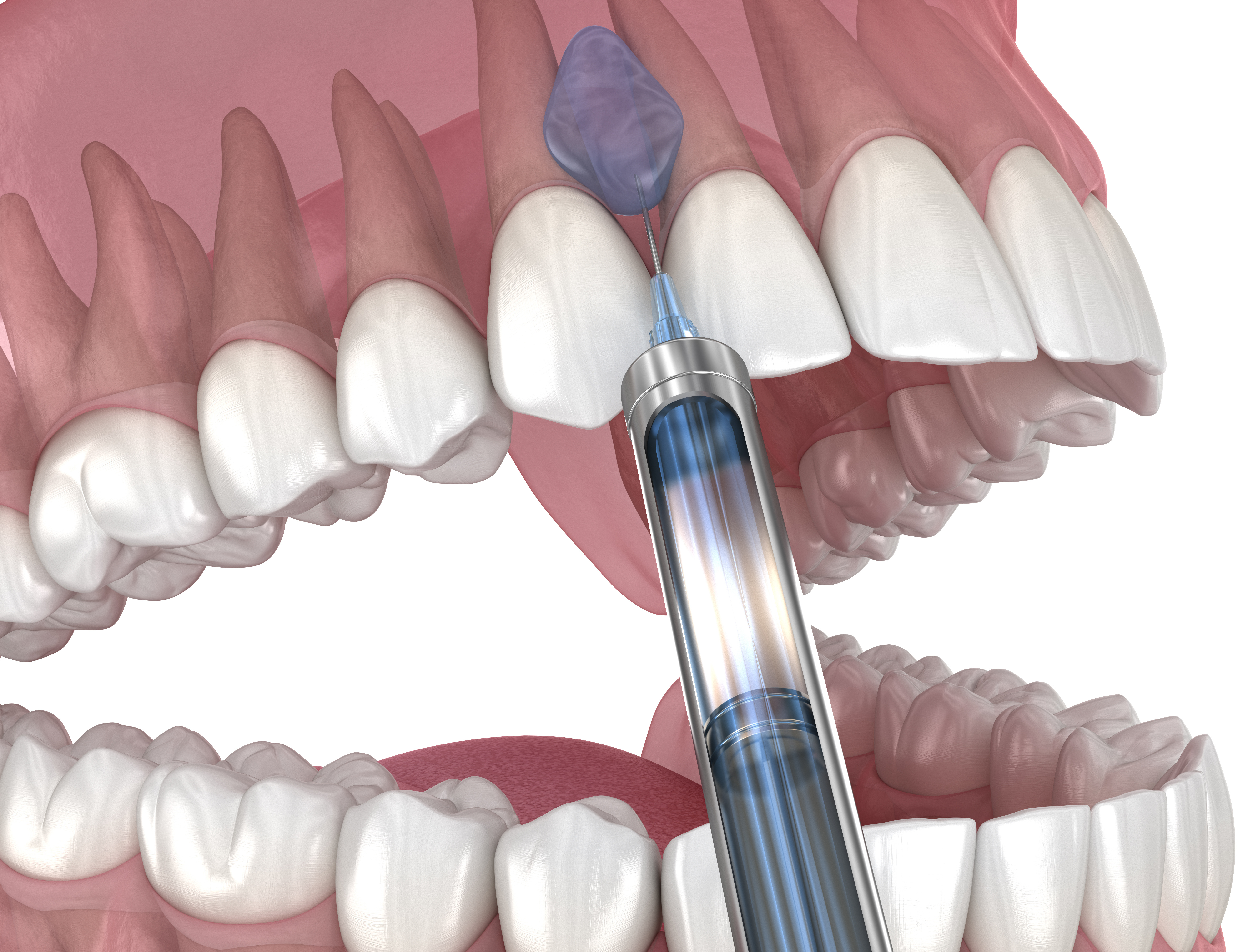 dental needle injecting anesthetic into maxillary