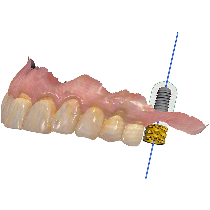 Graphic representation of dental implant services, featuring a lower jaw gum model with one tooth missing, and a dental implant being placed into the jawbone with a highlighted section showing the implant's structure.