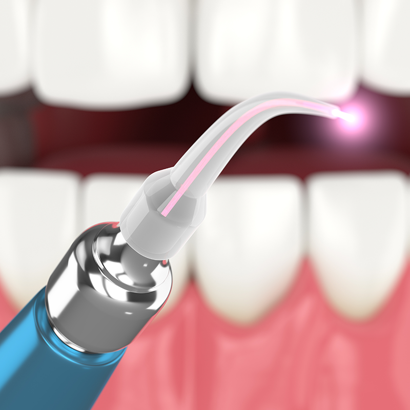Digital illustration of laser therapy being applied to gums, showing a hand-held dental laser with a glowing tip directed towards the inflamed gum area between two upper teeth.