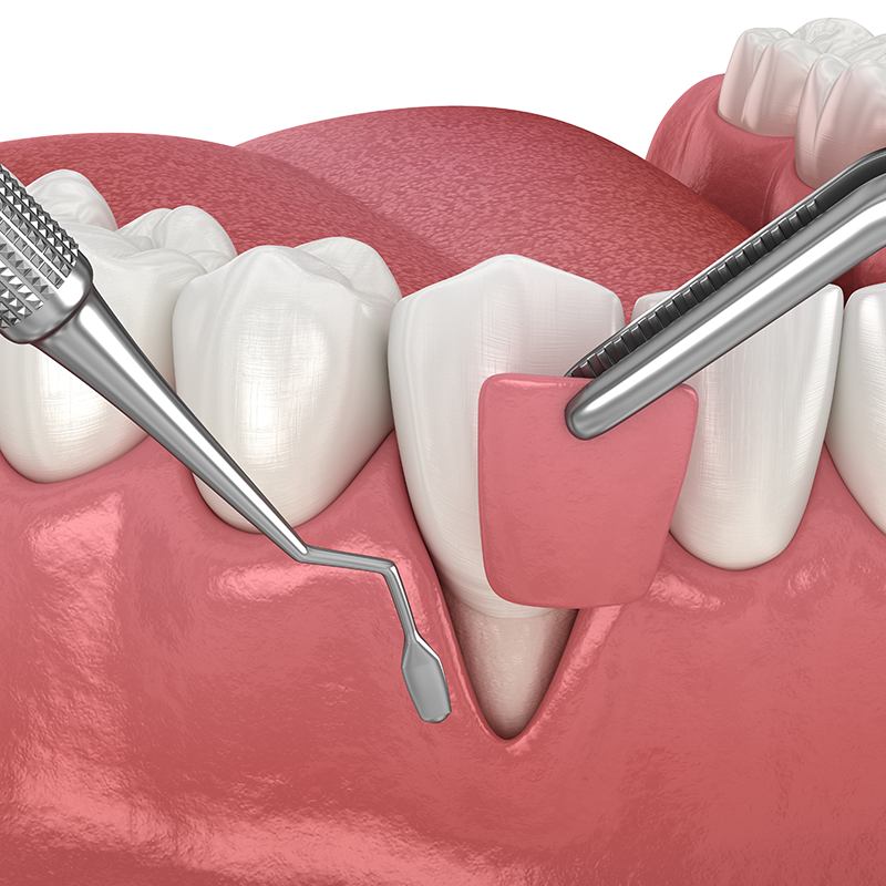 A 3D illustration of recession therapy, showing dental instruments adjusting a pink gum graft in place over an exposed tooth root for gum recession treatment.
