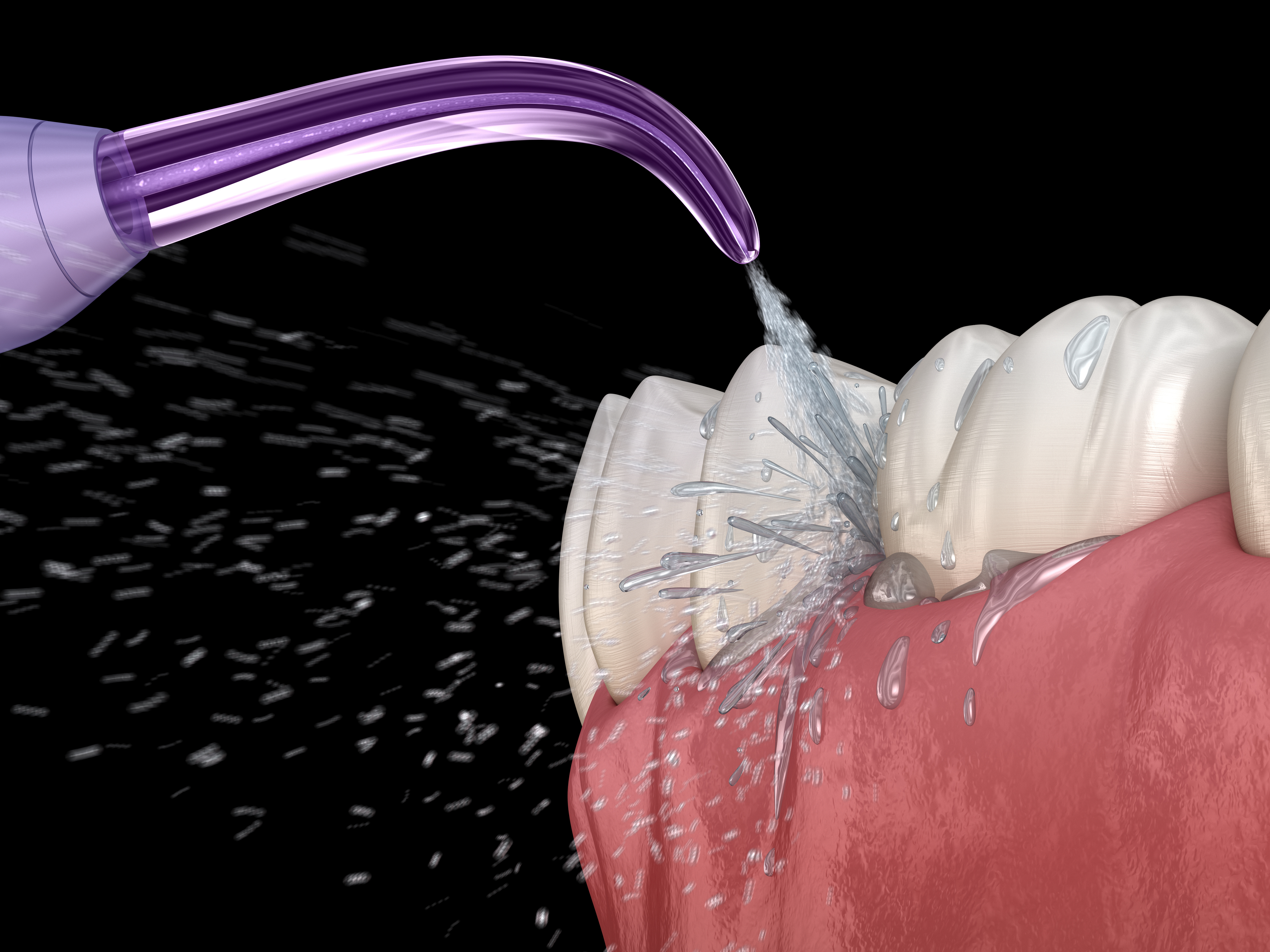 Illustration showing pressurized water coming from a purple tip of a oral irrigator (water pick) shooting in between two lower teeth