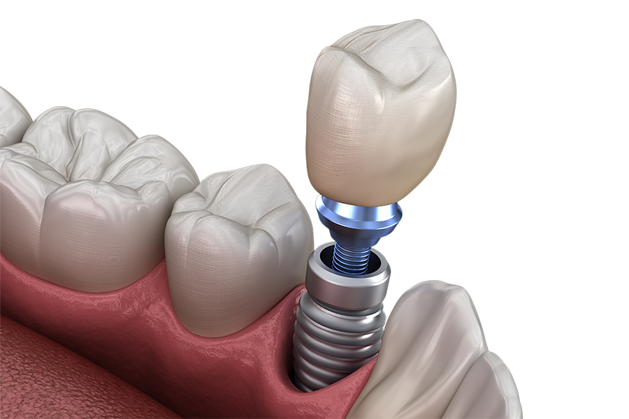 A close-up of 3D illustration of human teeth with an implant final crown being place