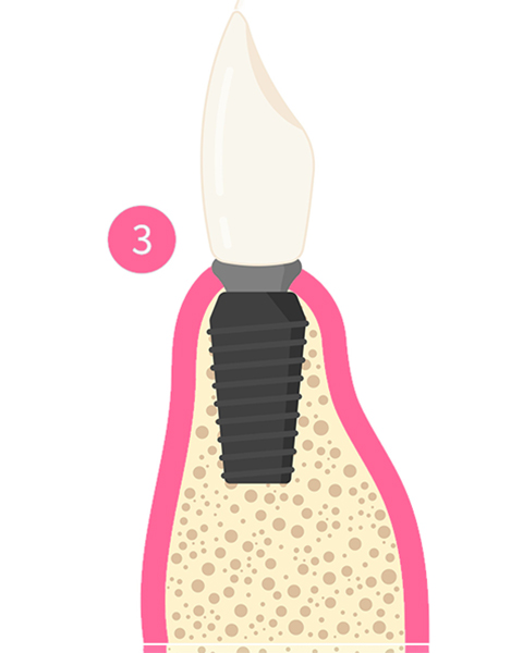cross section illustration of a dental implant placed in a jaw