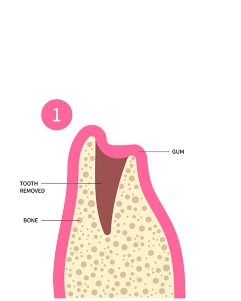 illustration of cross section of a tooth socket after extraction
