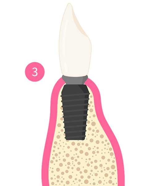 illustration of cross section of a tooth with implant placed