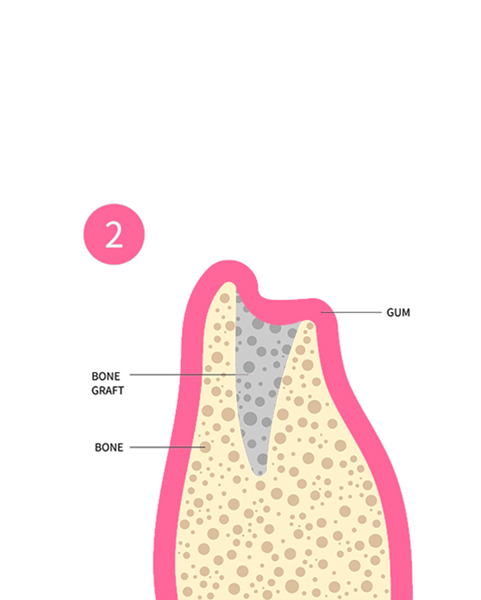 illustration of cross section of a tooth socket filled with bone grafting material
