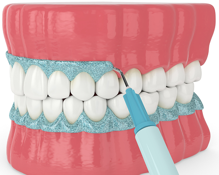 3d dental model with blue numbing gel around gums
