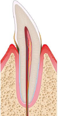 Illustration of periodontitis cross section of a tooth with some plaque build up showing swollen red gums and some bone loss