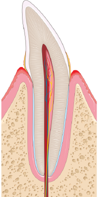 Illustration of gingivitis cross section of a tooth with swolen red gums, some plaque build up, bone is healthy 