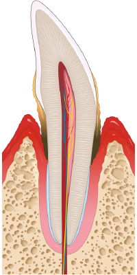 Illustration of Moderate Periodontitis cross section of tooth showing red inflamed gums pulling away from tooth showing build up below gum and bone loss