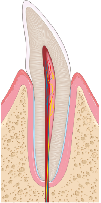 Illustration of cross section of tooth showing healthy pink gums and health bone