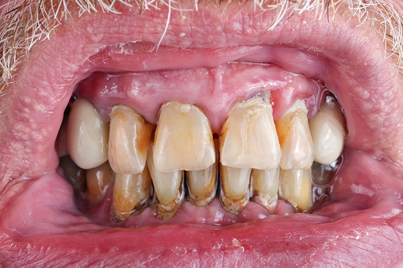 Photograph Close-up of teeth with severe periodontal disease, showing discoloration, plaque, inflamed gums, and decay
