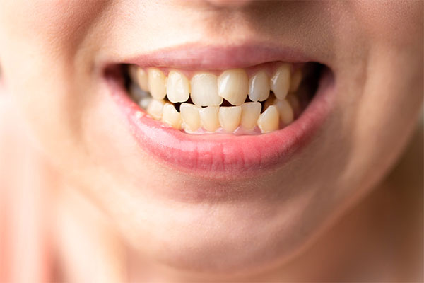 Smile with loose or shifting teeth, possibly due to advanced gum disease or bone loss.