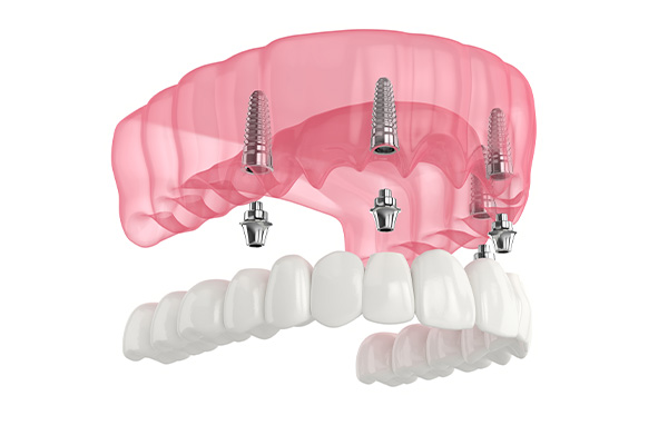 Image of a permeant screw retained maxallary all on 4 implant prosthesis.
