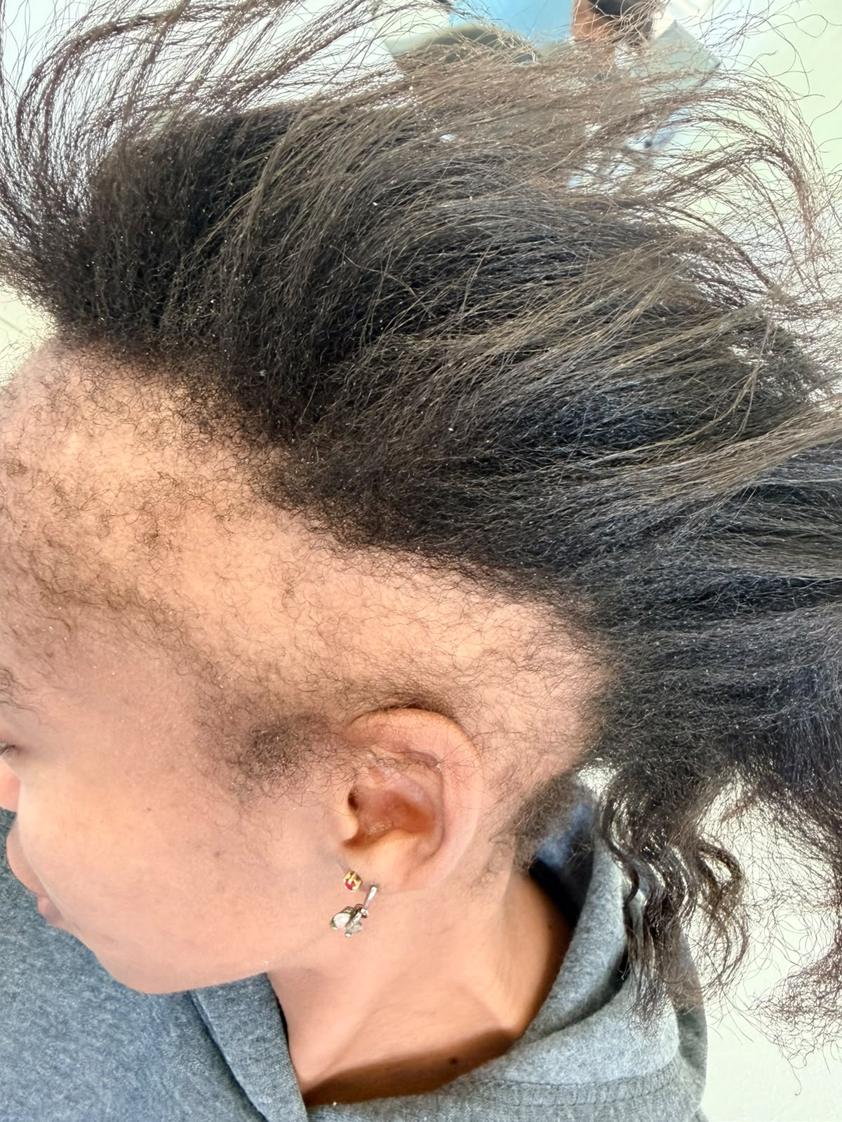 Before photograph 2 documenting this patient's hairline care