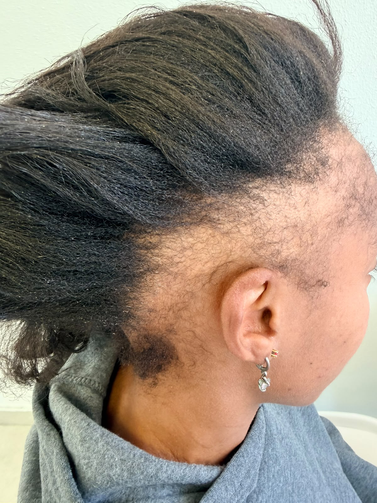 Before photograph 3 documenting this patient's hairline care