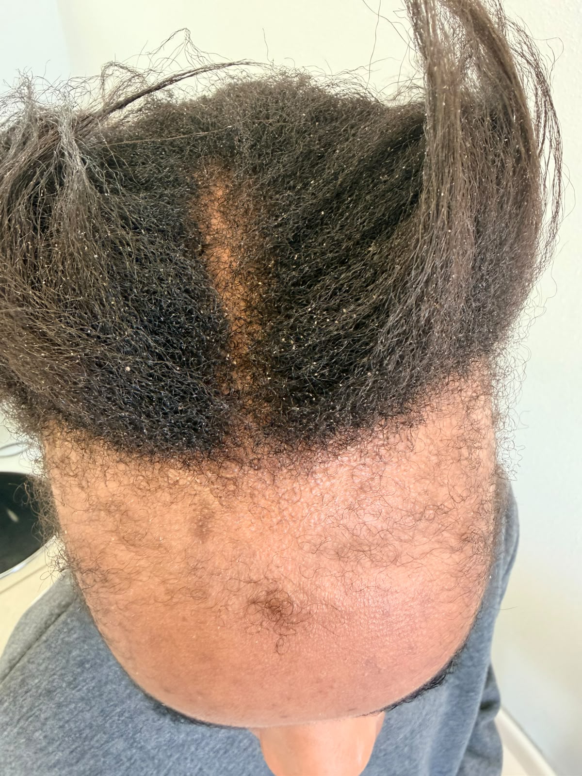 Before photograph 1 documenting this patient's hairline care