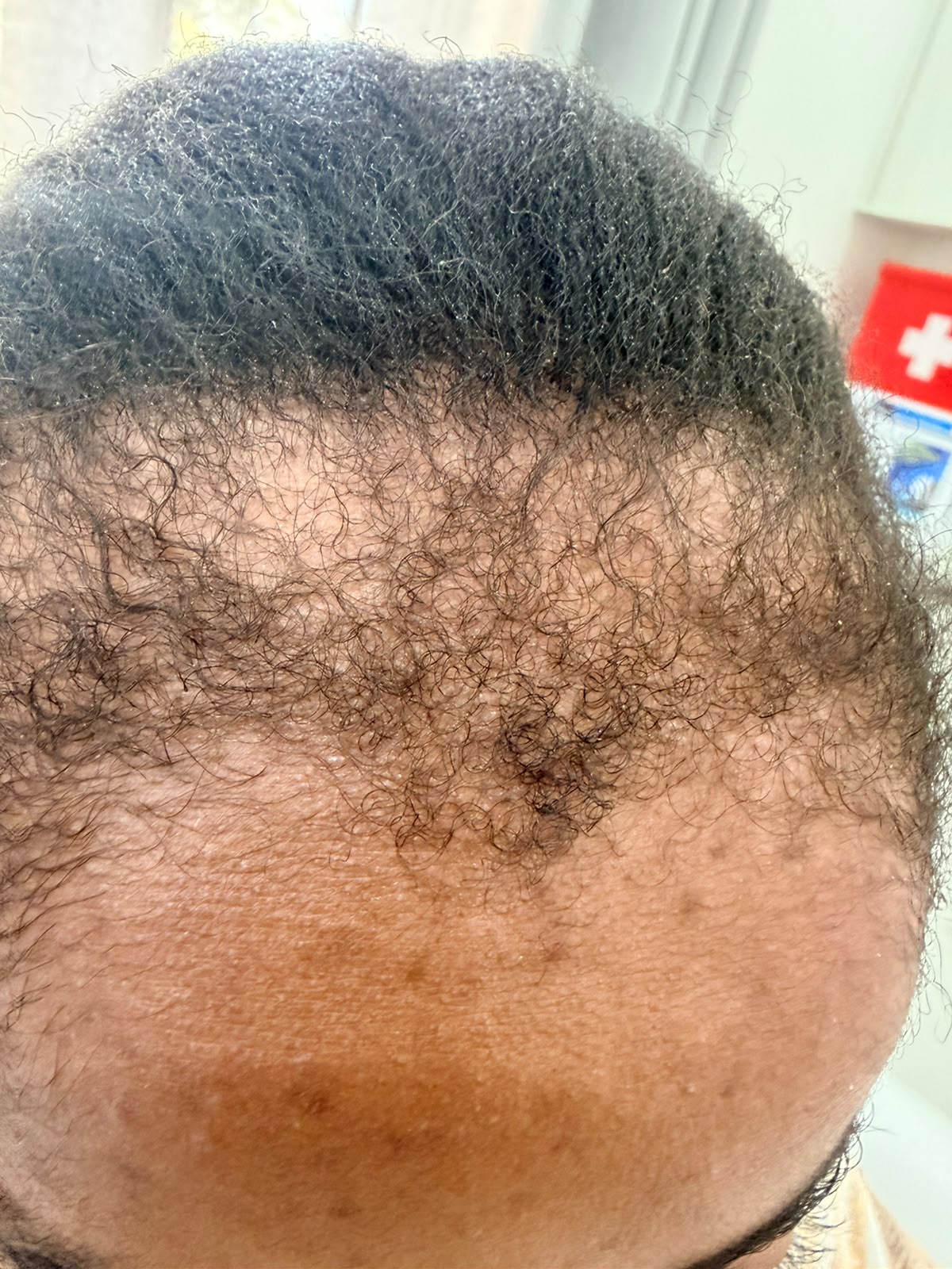 During photograph 4 documenting this patient's hairline care