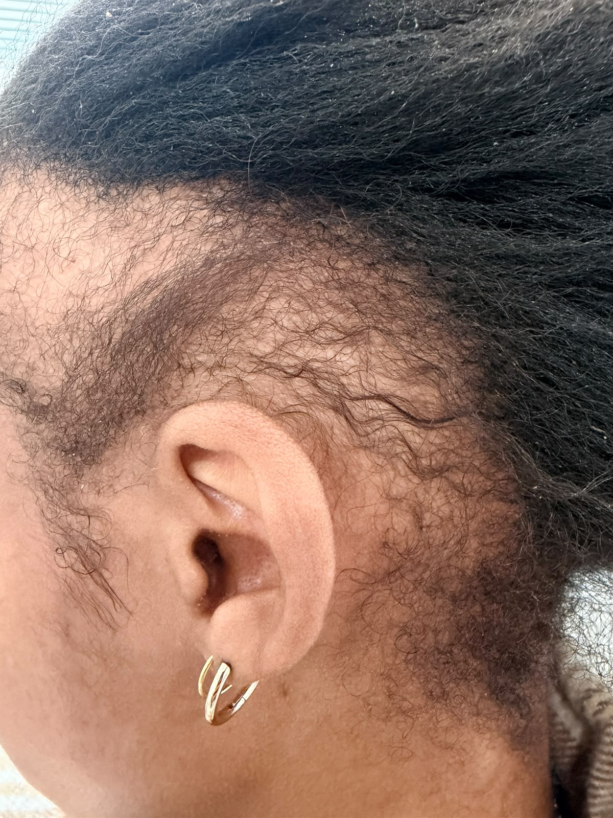 During photograph 3 documenting this patient's hairline care