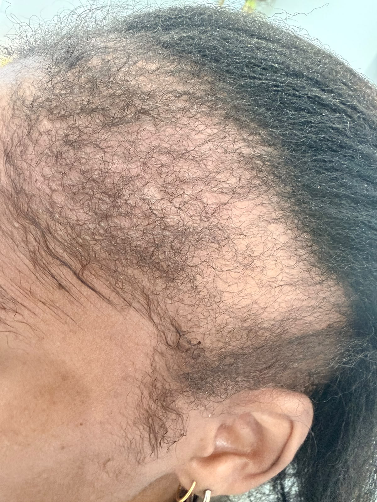 During photograph 2 documenting this patient's hairline care