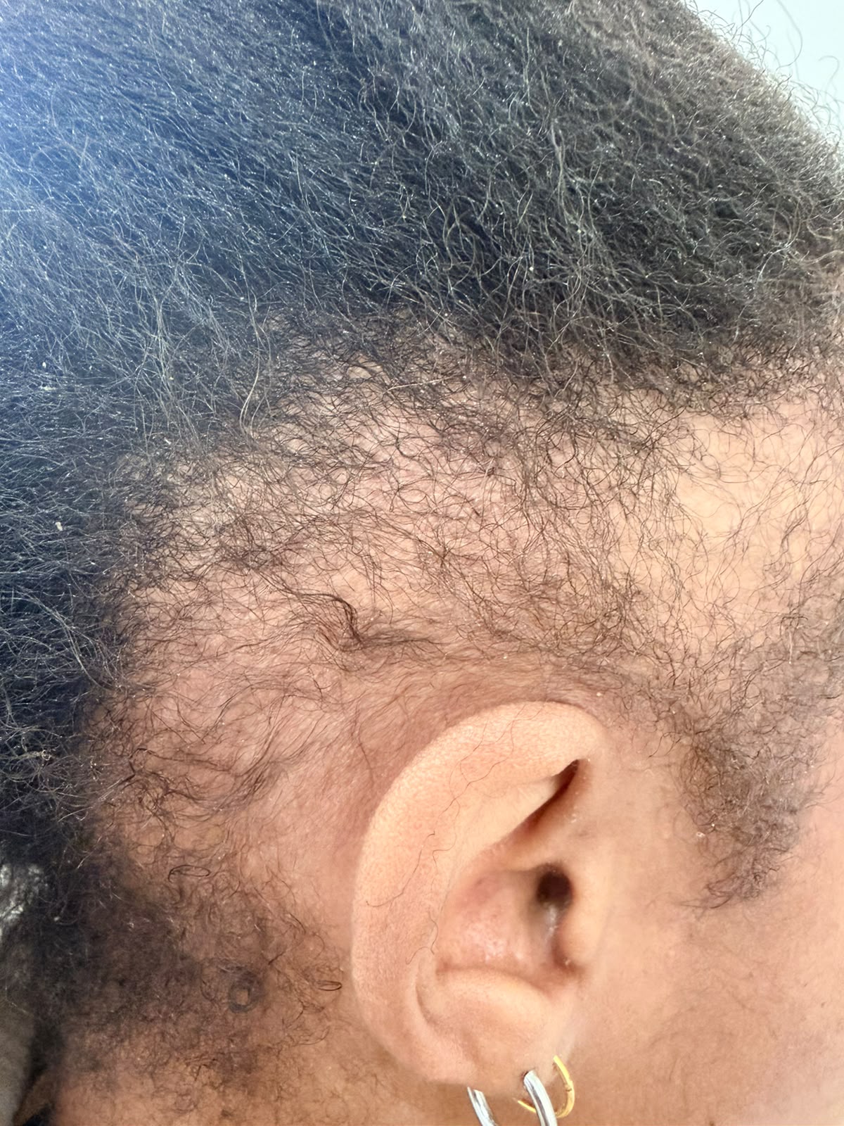 During photograph 1 documenting this patient's hairline care