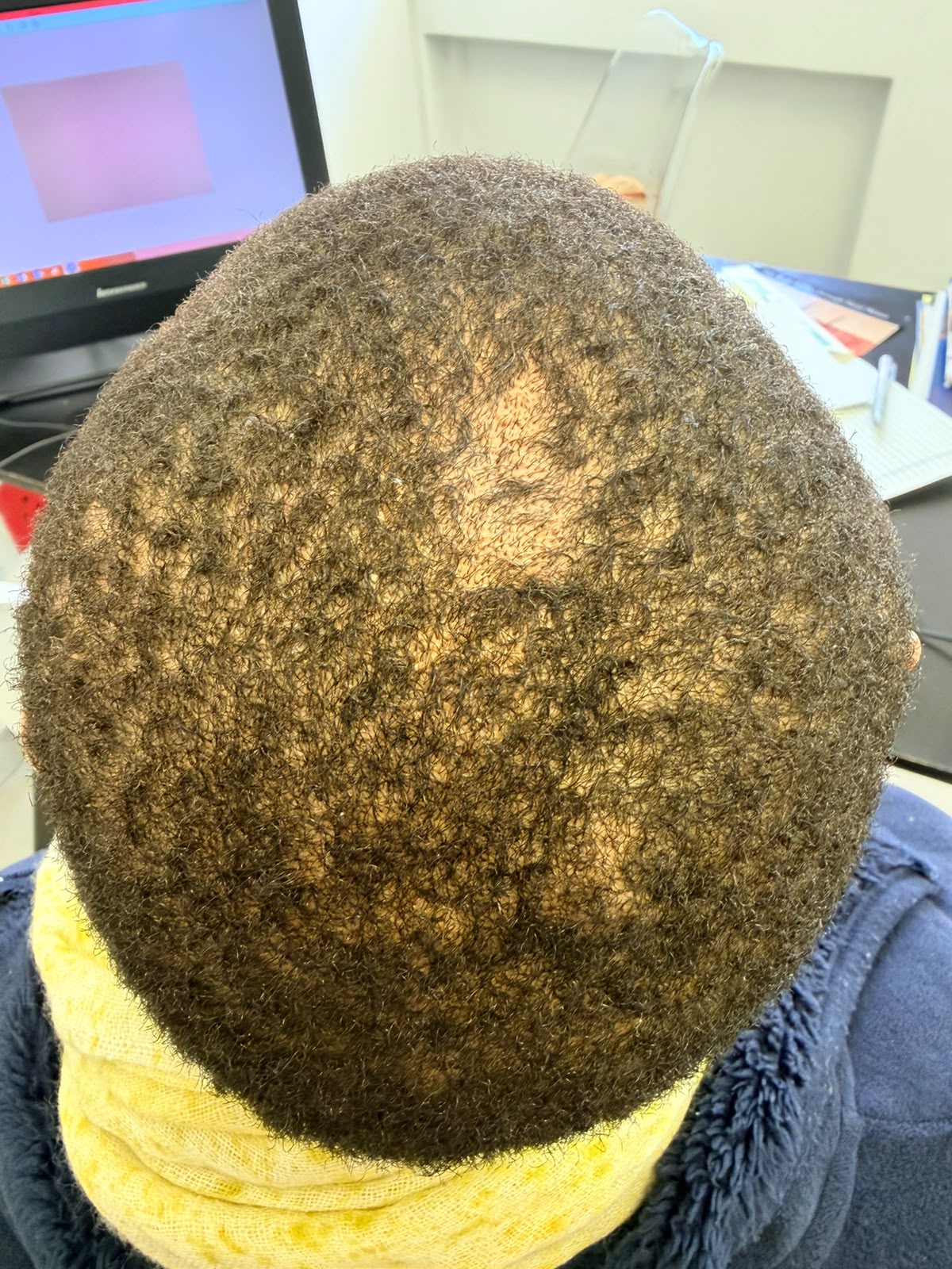 During photograph: Two months of targeted treatment for the fungal infection.