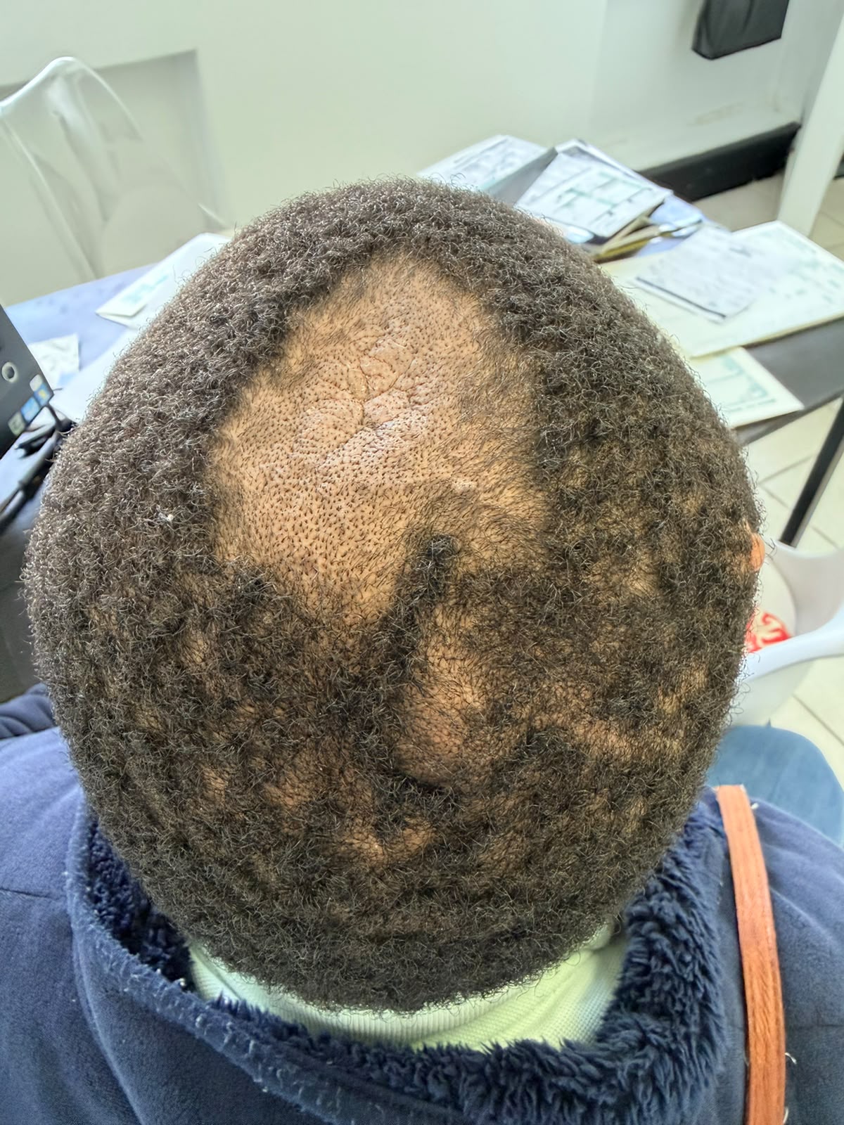 Before photograph: The scalp at the start of assessment, before treatment.