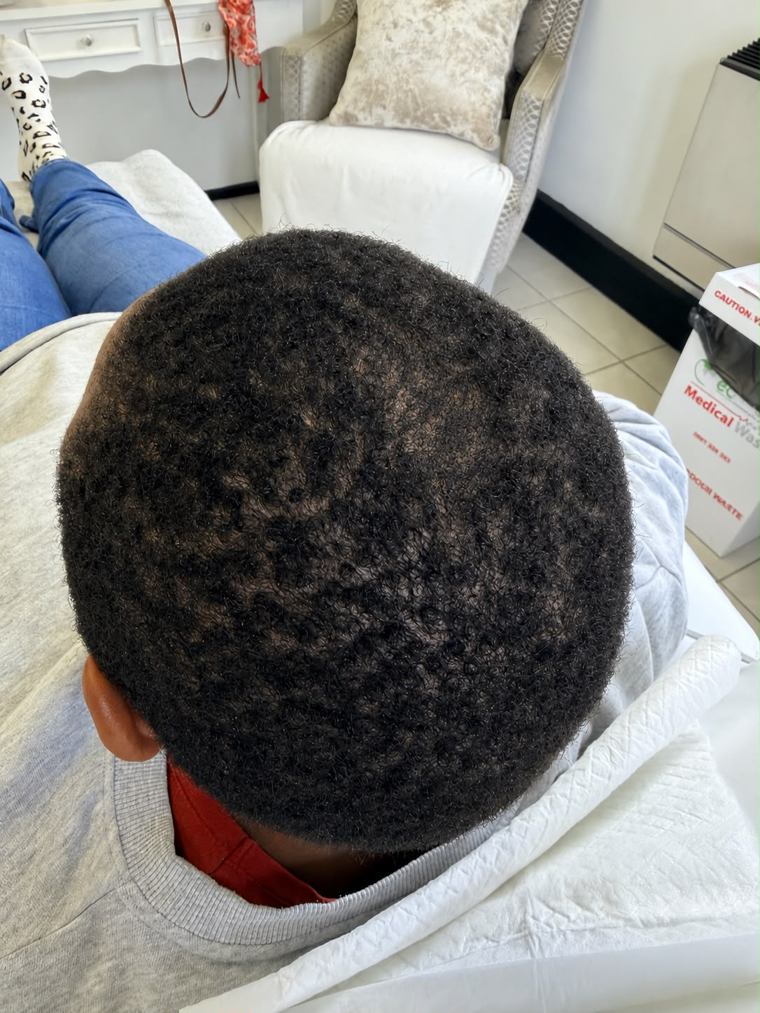 After photograph: The scalp after two months of treatment.
