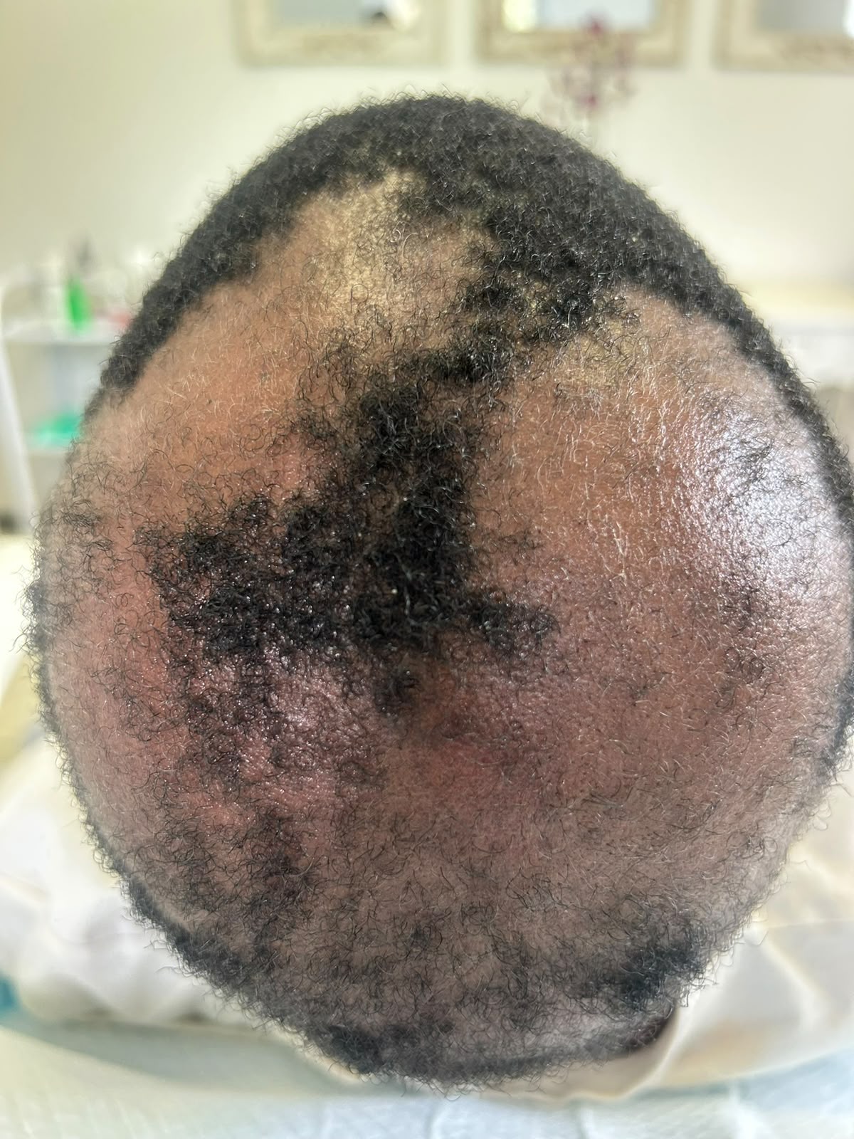 Before photograph: severe hair loss at the start of assessment in November 2025