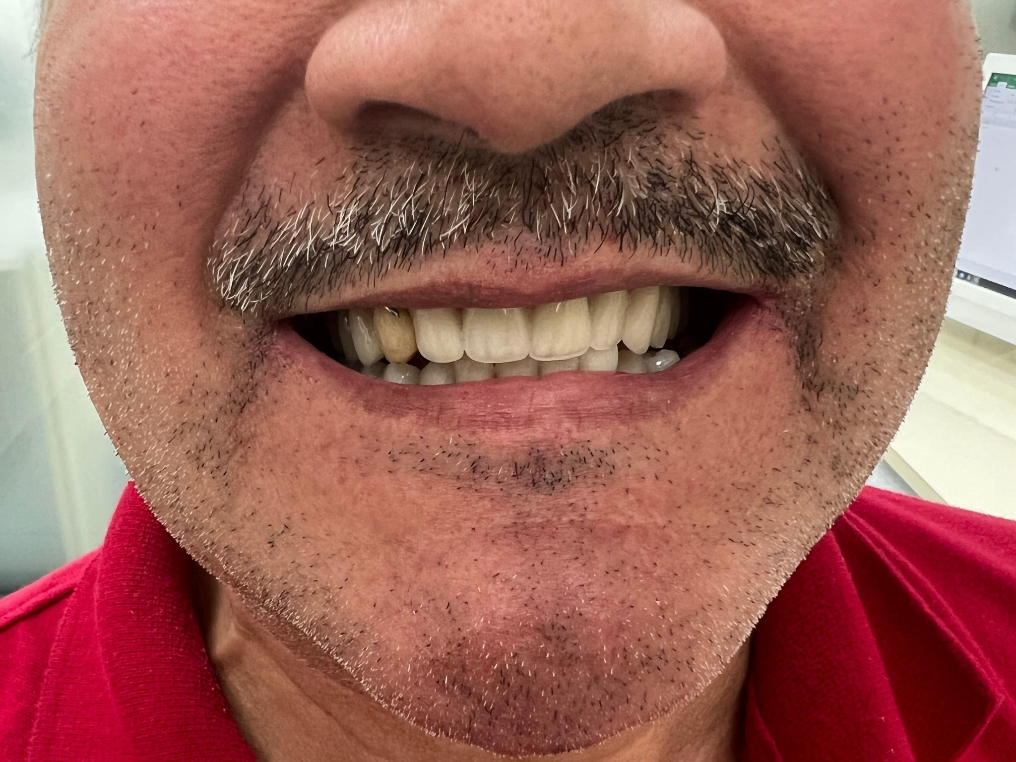 Antes