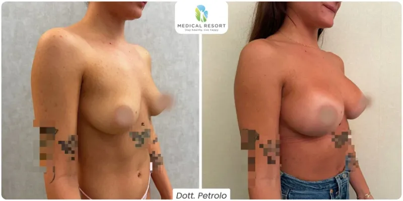 Prima e dopo mastoplastica additiva