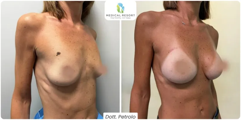 Prima e dopo mastoplastica additiva