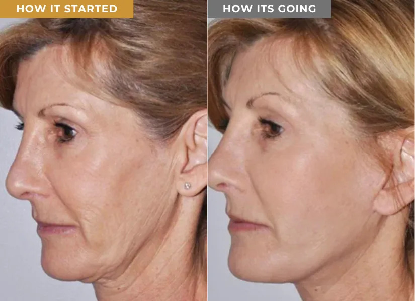 Morpheus8 before and after — skin tightening around the mouth and neck