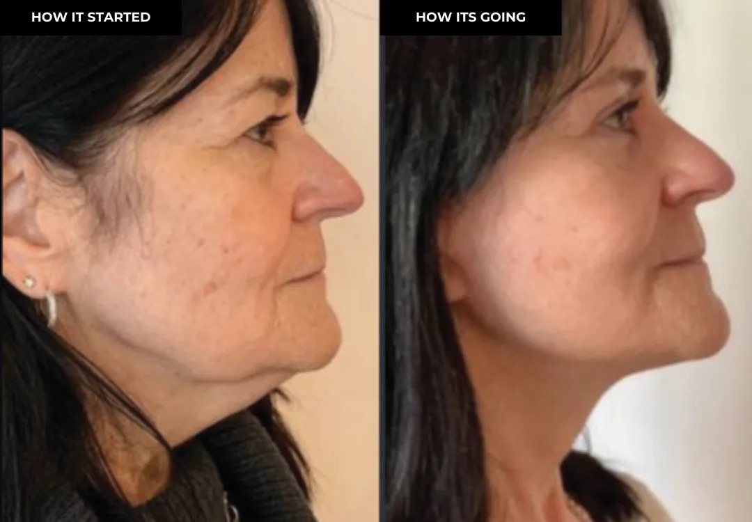 Morpheus8 before and after — smoother texture and even tone