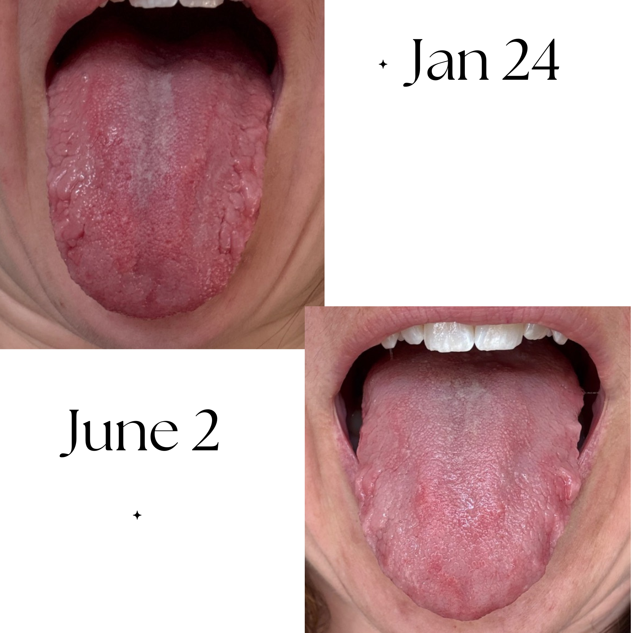 Tongue comparison 3: Jan 24 - June 2